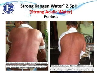 Strong Acidic Water pH 2.5 - Eczema
Strong Kangen Water® 2.5pH
(Strong Acidic Water)
Psoriasis
 