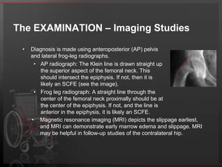 The radiographic classification depends onthe presence or absence of a hip effusion on ultrasonography.If the ultrasound demonstrates the absence of metaphyseal remodelingand the presence of an effusion, an acute event is likely tohave occurred and the slipped capital femoral epiphysis is consideredunstable. If the ultrasound demonstrates metaphyseal remodelingand the absence of an effusion, an acute event has not occurredand the slipped capital femoral epiphysis is considered stable.CLINICAL - historyMost common in the adolescent period. Males have 2.4 times the risk compared with females.The left hip is affected more commonly than the right.Obesity is a risk factor because it places more shear forces around the proximal growth plate in the hip.The duration, location, and radiation of pain are important, as is the ability to bear weight.Genetics may play a role in SCFE because the rate of familial involvement is 5-7%, with a large variability in penetrance.In patients younger than 10 years, SCFE is associated with metabolic endocrine.Bilaterality is more common in these younger patients.The chronicity of the condition should be determined.Prodromal symptoms for less than 3 weeks are deemed acute. for longer than 3 weeks are deemed chronic.If a patient reports symptoms of greater than 3 weeks' duration but presents with an acute exacerbation of pain, limp, inability to bear weight, or decreased range of motion with or without an associated traumatic episode, the SCFE is categorized as acute on chronic.Determine if a traumatic episode occurred.It is important to determine if the lesion is stable or unstable."Stable" SCFEs allow the patient to ambulate with or without crutches."Unstable" SCFEs do not allow the patient to ambulate at all.