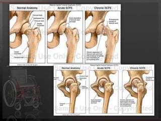 The CLASSIFICATIONSlipped capital femoral epiphysis is classified according to boththe clinical nature and the magnitude of the disorder. The traditionalclinical categories are pre-slip, acute, chronic, and acute-on-chronic.In the pre-slip stage, patients usually complain of weakness inthe leg, limping, or pain in the groin or the knee on exertion. An acute slipped capital femoral epiphysis is an abrupt displacement throughthe proximal physis in which there was a preexisting epiphysiolysis.Patients with a chronicslipped capital femoral epiphysis present with pain in the groin,thigh, and knee that varies in duration, often ranging frommonths to yearsAn acute-on-chronic slipped capital femoral epiphysis is one associatedwith chronic symptoms initially and with subsequent development ofacute symptoms as well as a sudden increase in the degree of slip