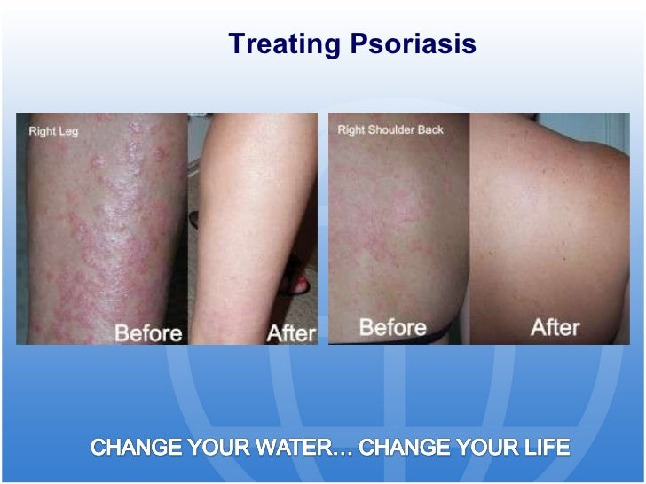 kangen water and eczema