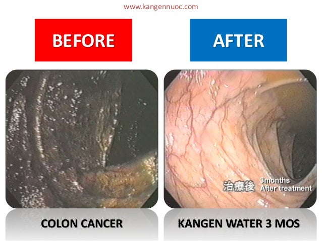 kangen water colon cancer