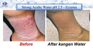 Before After kangen Water
Strong Acidic Water pH 2.5 - Eczema
 