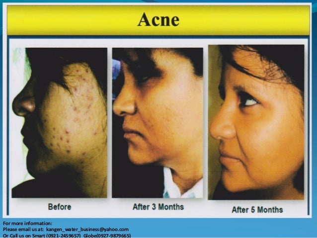 kangen water for acne