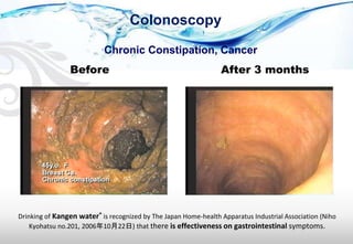 Chronic Constipation, Cancer
Colonoscopy
After 3 monthsBefore
Drinking of Kangen water® is recognized by The Japan Home-health Apparatus Industrial Association (Niho
Kyohatsu no.201, 2006年10月22日) that there is effectiveness on gastrointestinal symptoms.
 