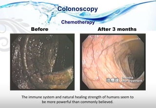 Chemotherapy
After 3 monthsBefore
The immune system and natural healing strength of humans seem to
be more powerful than commonly believed.
Colonoscopy
 