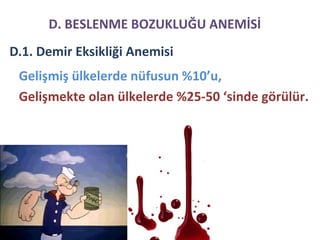 D.1. Demir Eksikliği Anemisi
Gelişmiş ülkelerde nüfusun %10’u,
Gelişmekte olan ülkelerde %25-50 ‘sinde görülür.
D. BESLENME BOZUKLUĞU ANEMİSİ
 