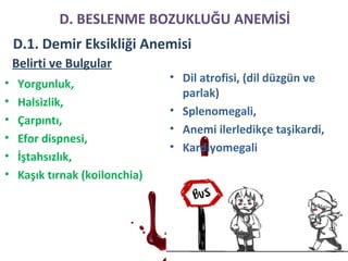 Belirti ve Bulgular
• Yorgunluk,
• Halsizlik,
• Çarpıntı,
• Efor dispnesi,
• İştahsızlık,
• Kaşık tırnak (koilonchia)
• Dil atrofisi, (dil düzgün ve
parlak)
• Splenomegali,
• Anemi ilerledikçe taşikardi,
• Kardiyomegali
D. BESLENME BOZUKLUĞU ANEMİSİ
D.1. Demir Eksikliği Anemisi
 
