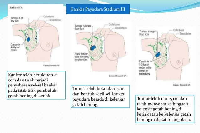 Tanda Kanker Payudara Yang Sudah Menyebar