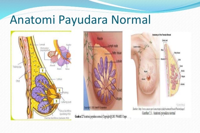 Gambar Kanker Payudara Kanker Payudara