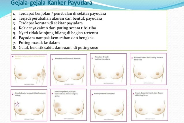 Kanker Payudara
