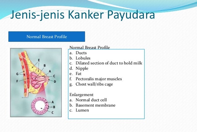 Payudara Invasif Jenis Kanker Lobular