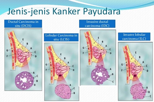 Kanker Payudara Kanker Payudara