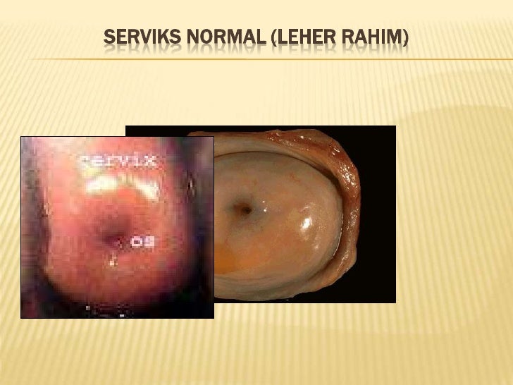 Kanker Leher Rahim dan Pencegahannya