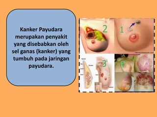 Kanker Payudara
merupakan penyakit
yang disebabkan oleh
sel ganas (kanker) yang
tumbuh pada jaringan
payudara.