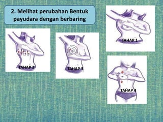 2. Melihat perubahan Bentuk
payudara dengan berbaring
TAHAP 2
TAHAP 1
TAHAP 4
TAHAP 3