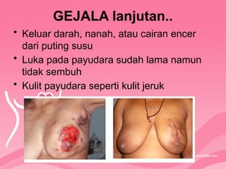 GEJALA lanjutan..
• Keluar darah, nanah, atau cairan encer
dari puting susu
• Luka pada payudara sudah lama namun
tidak sembuh
• Kulit payudara seperti kulit jeruk
 