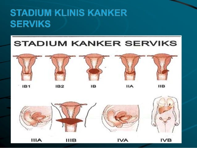  Kanker  serviks 