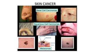 SKIN CANCER
 