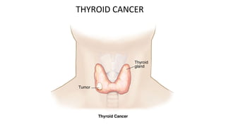 THYROID CANCER
 