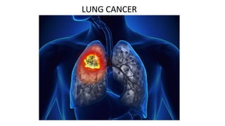 LUNG CANCER
 