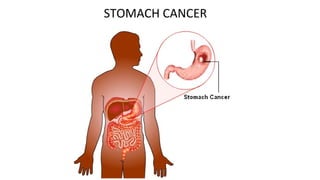 STOMACH CANCER
 