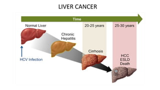 LIVER CANCER
 