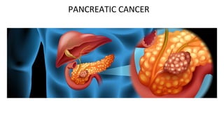 PANCREATIC CANCER
 