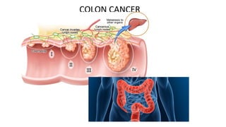 COLON CANCER
 