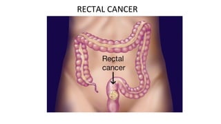 RECTAL CANCER
 