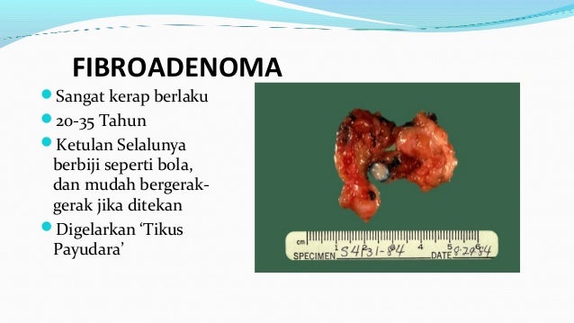 Penyakit Kanser Payudara