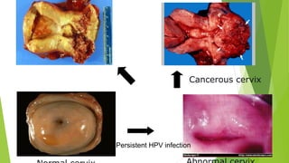 Cancerous cervix
Persistent HPV infection
 