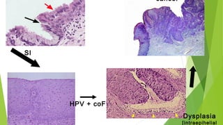 Dysplasia
[intraepihelial
cancer
SI
HPV + coF
 