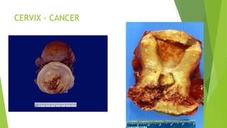 CERVIX - CANCER
 