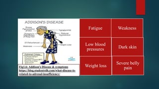 Disorder of adrenal gland & their causes | PDF