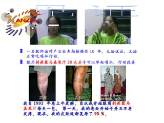 我自 1993  年患上牛皮癣。自从我开始服用 刺蒺藜马嘉果汁 每天一包。 第一天，我的患处开始干并且不再发痒。现在，我的皮肤逐渐复原了 90 ％ 。  之前 之后 Wahid B. Bakar 53 tahun  一名教师面对产后全身抽筋痛苦 10  年，无法说话，无法正常吃喝和行动。 服用 刺蒺藜马嘉果汁 20 天后 手可以举起喝水，行动改善 见证 