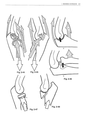 1. MEMBRO SUPERIOR   103




                        a




Fig.2-44   Fig.2-45


                            Fig.2-46
 