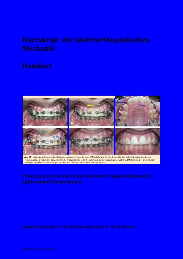 Kapitel 5 Einzelzahnbewegungen Einstellen Von Eckzahnen