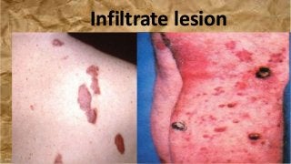 Infiltrate lesion
 