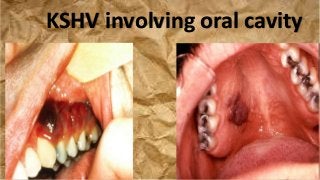 KSHV involving oral cavity
 