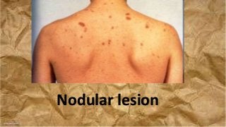 Nodular lesion
 