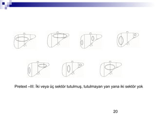 20
Pretext –III: İki veya üç sektör tutulmuş, tutulmayan yan yana iki sektör yok
 