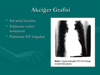 Akciğer Grafisi Sol atrial büyüme Pulmoner venöz konjesyon Pulmoner HT bulguları 