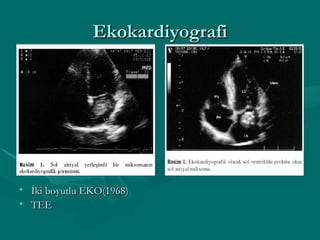 Ekokardiyografi İki boyutlu EKO(1968) TEE 