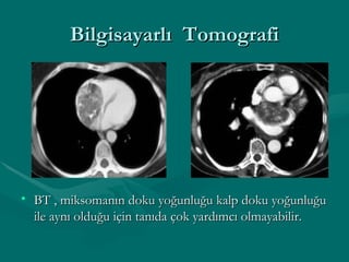 Bilgisayarlı  Tomografi BT , miksomanın doku yoğunluğu kalp doku yoğunluğu ile aynı olduğu için tanıda çok yardımcı olmayabilir. 