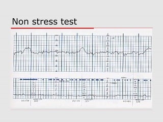Non stress test
 
