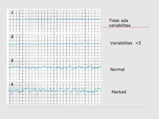 Tidak ada
variabilitas
Variabilitas <5
Normal
Marked
 