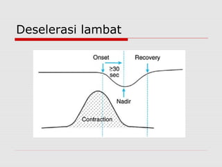 Deselerasi lambat
 