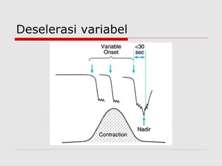 Deselerasi variabel
 