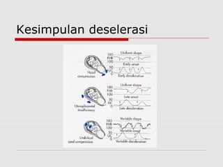 Kesimpulan deselerasi
 