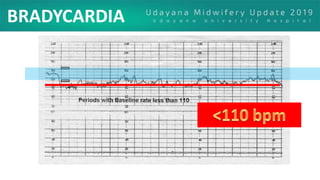 BRADYCARDIA
 